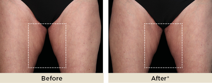 BA_thumbnail_neoemsculpt1