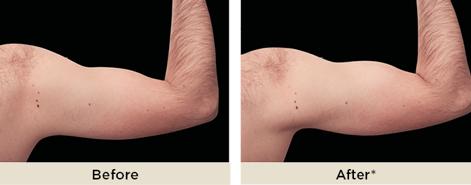 BA_thumbnail_neoemsculpt6