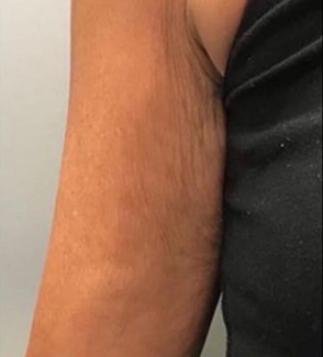 Profhilo-Arm-1_after