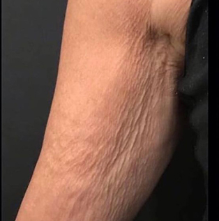 Profhilo-Arm-1_before