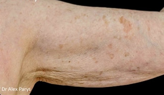 Profhilo-Arm-2_before