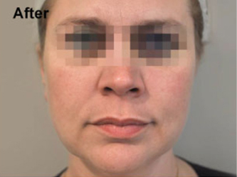 Profhilo-Face-3_after