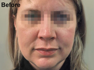 Profhilo-Face-3_before