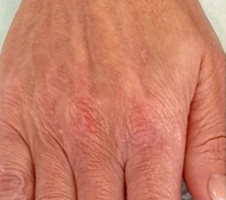 Profhilo-hands_1-before