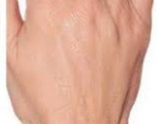 Profhilo-hands_2-after