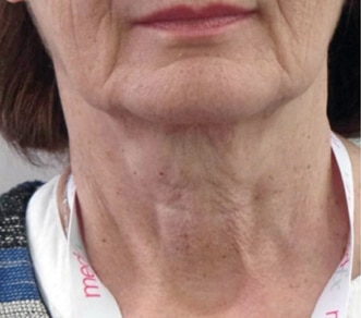 Profhilo-neck_1-before