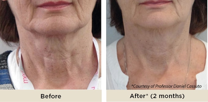 RR_Profhilo_before_after
