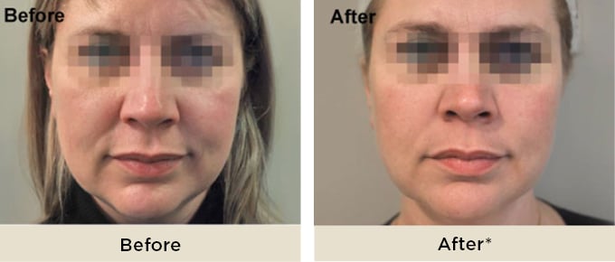 RR_Profhilo_before_after4