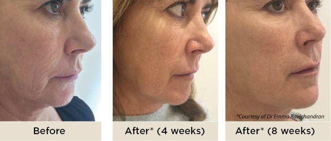 RR_Profhilo_before_after5