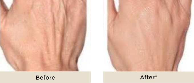 RR_Profhilo_before_after_hands