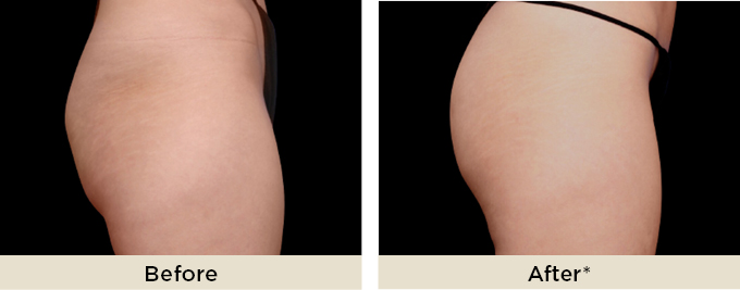 beforeafter_emsculptneo10