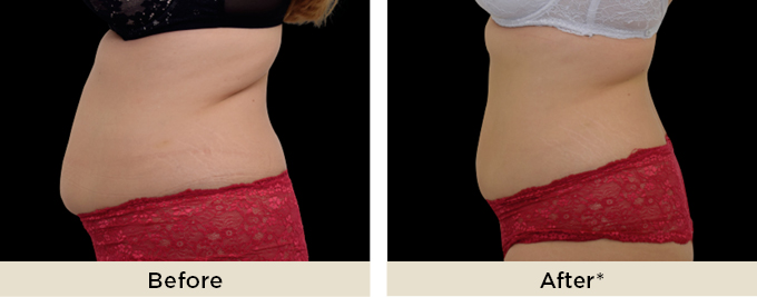 beforeafter_emsculptneo5