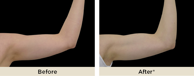 beforeafter_emsculptneo7