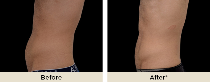 beforeafter_emsculptneo8