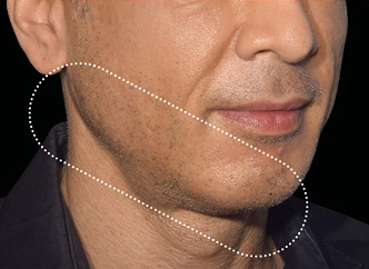 Non-surgical-13-before