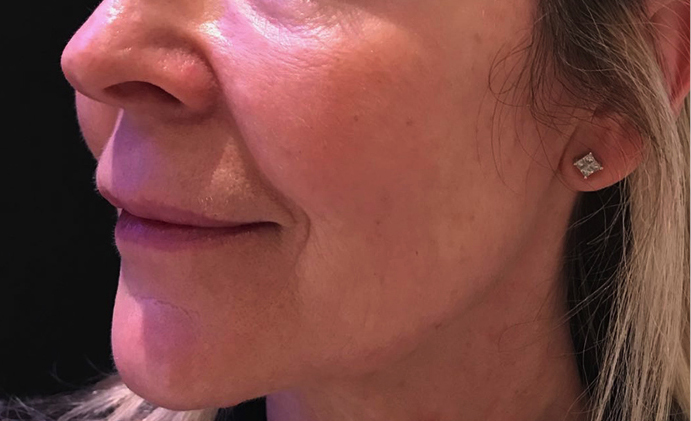 Non-surgical-3-after