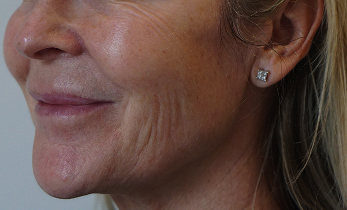 Non-surgical-3-before