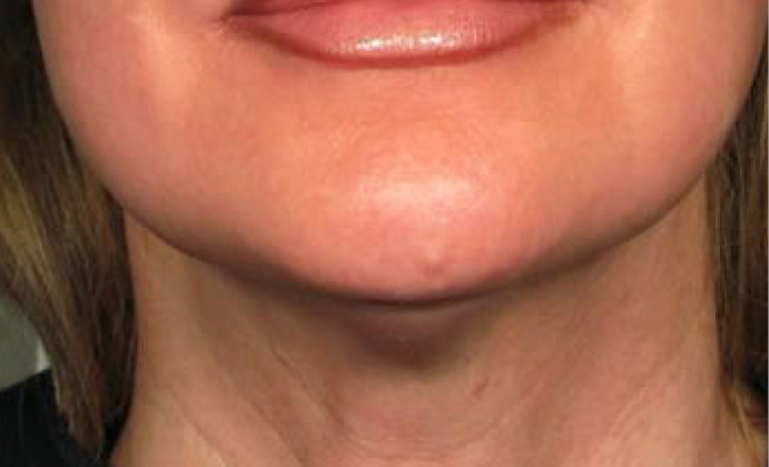 Non-surgical-4-after