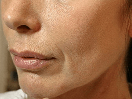 Non-surgical-5-after