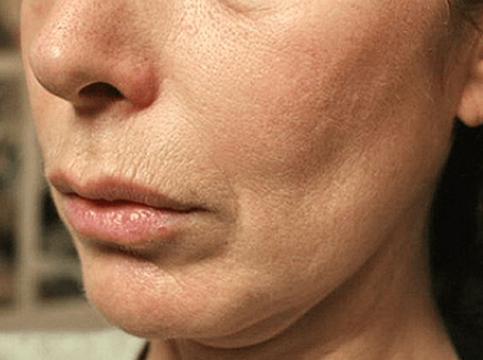 Non-surgical-5-before