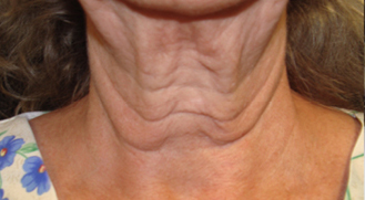 Non-surgical-6-before