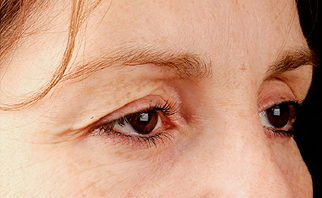 Non-surgical-7-before