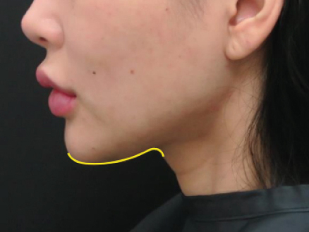 Non-surgical-9-after