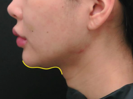 Non-surgical-9-before