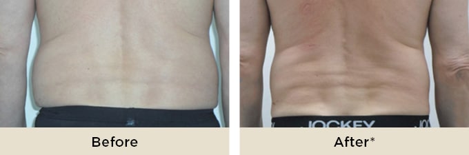 RR_IceAesthetics_BeforeAfter