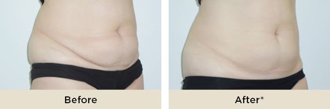 RR_IceAesthetics_BeforeAfter2