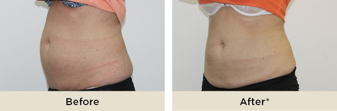 RR_IceAesthetics_BeforeAfter3