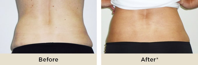 RR_IceAesthetics_BeforeAfter4