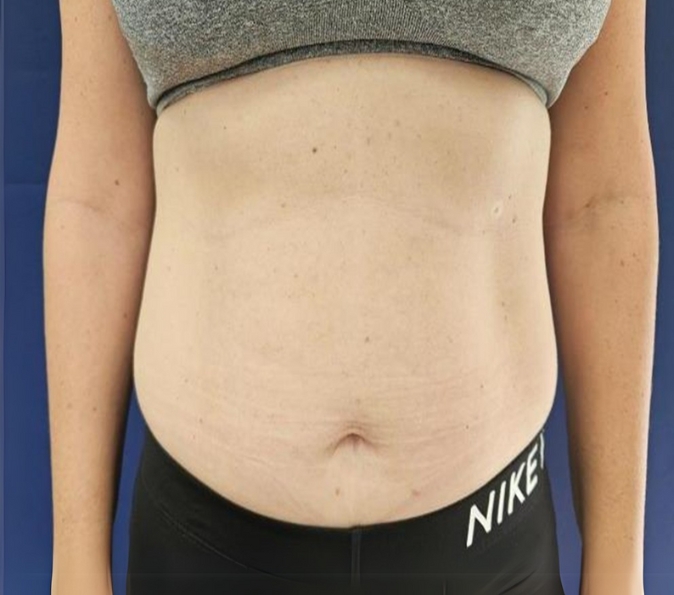 Abdominal-Sofwave-Clinic-after-p229-1