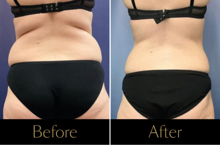 Rakus-Emerald-Before-After