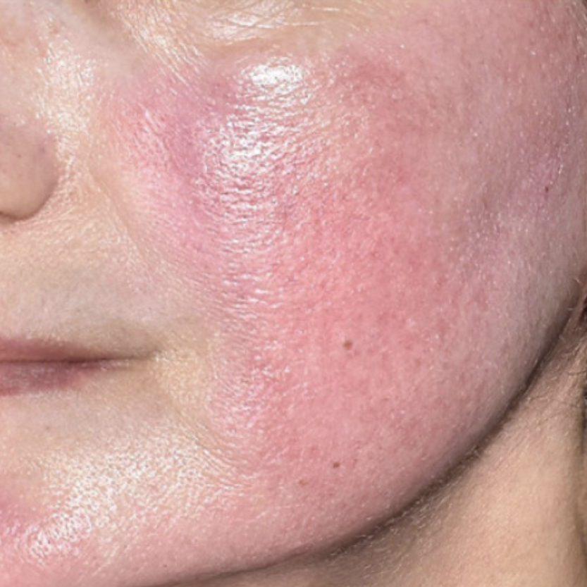 Rakus-beforeafter-advatx