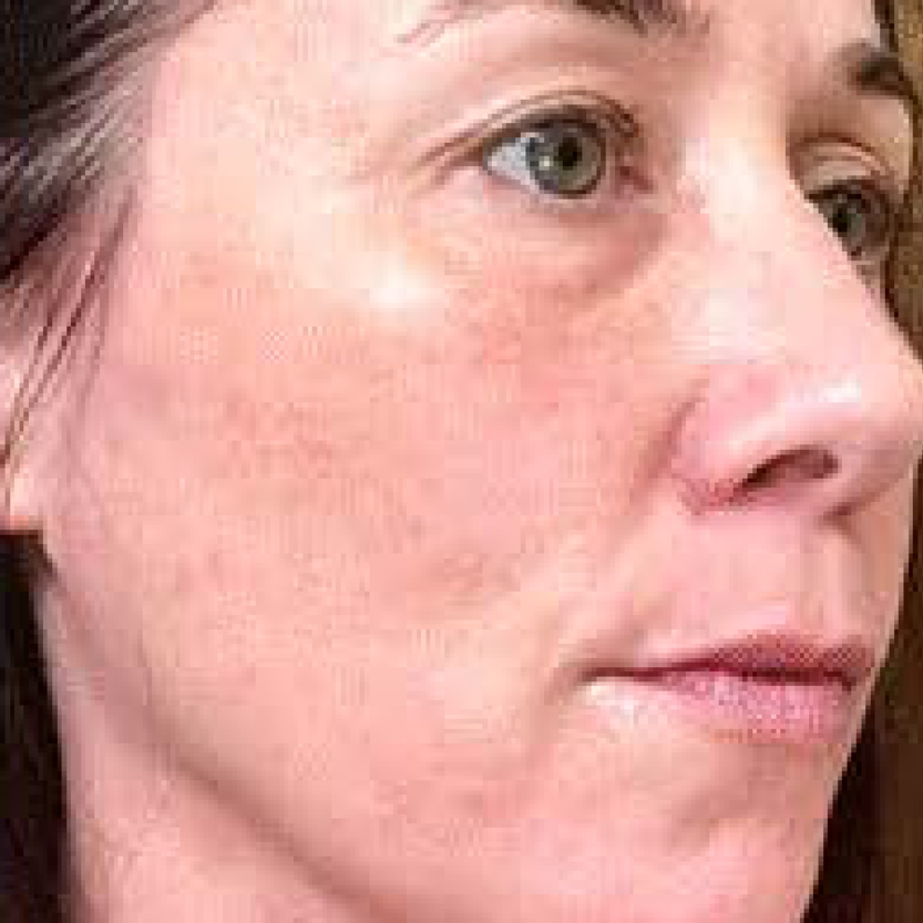 Rakus-beforeafter-advatx4