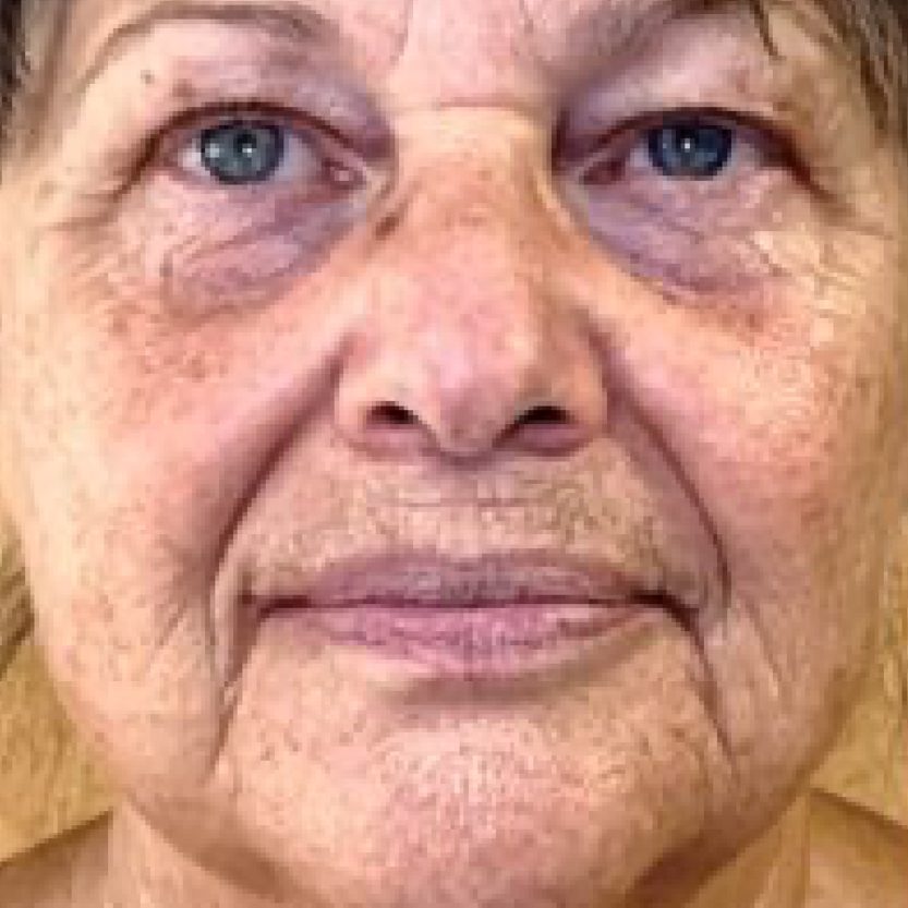 Rakus-beforeafter-advatx5