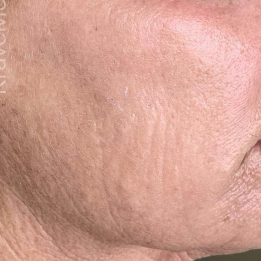 Rakus-beforeafter-advatx8