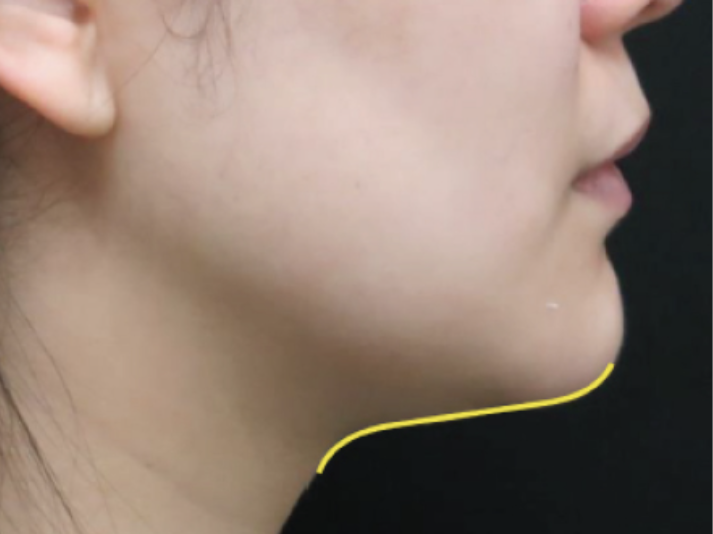 Ultracel Q+ Rakus Clinic