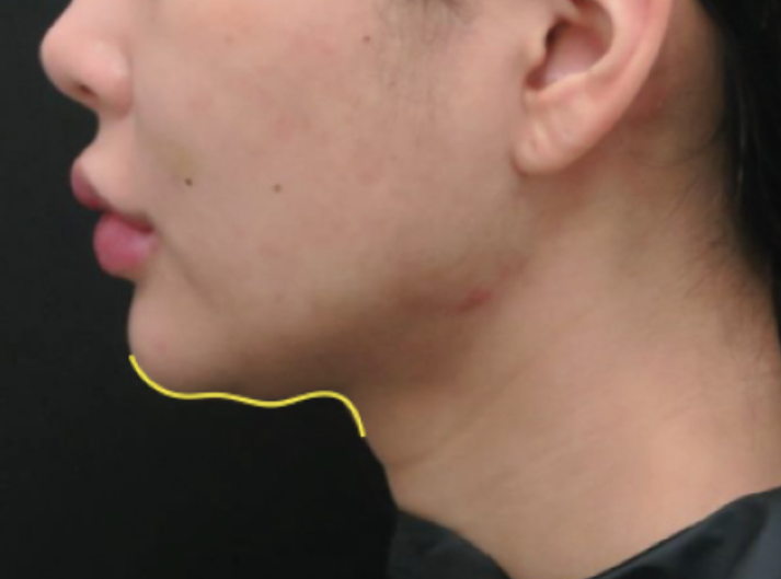 UltracelQ+ Before - Rakus Clinic