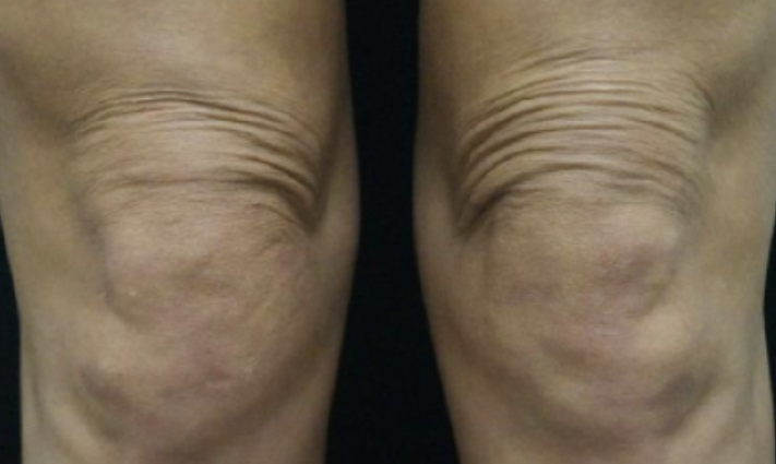 UltracelQ+ Rakus Clinic