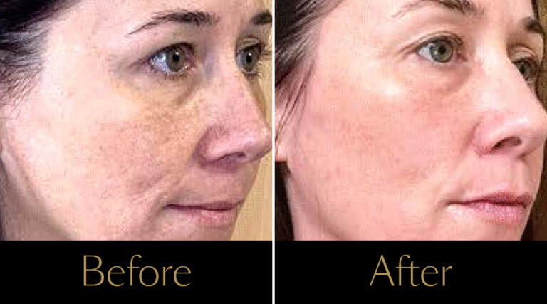 advatx-before-after12