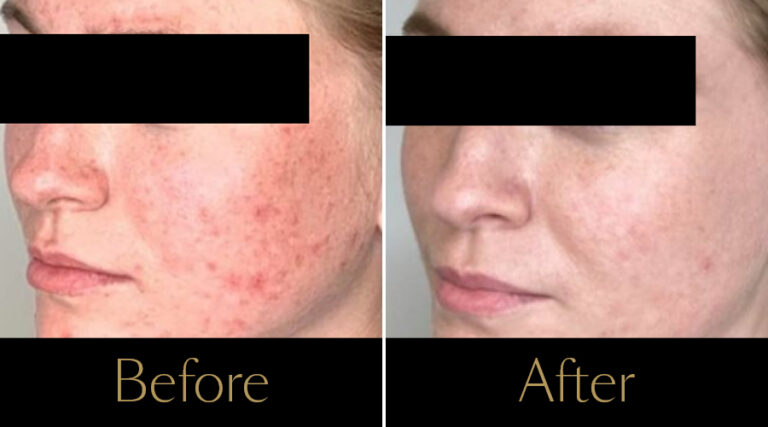 advatx-before-after13