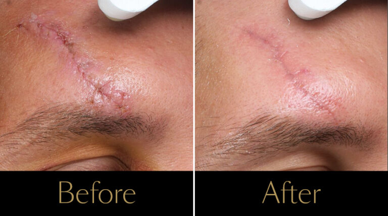 advatx-before-after14