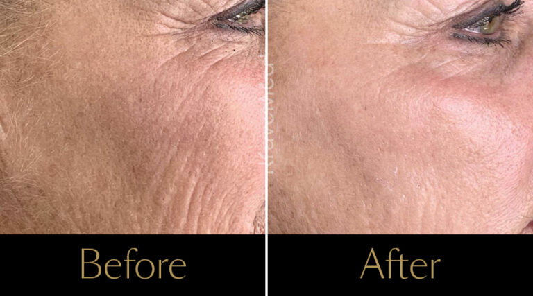 advatx-before-after15