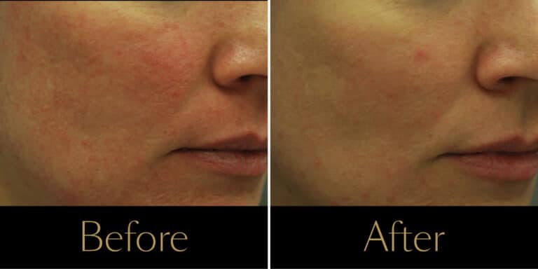 morpheus8-before-after-gallery