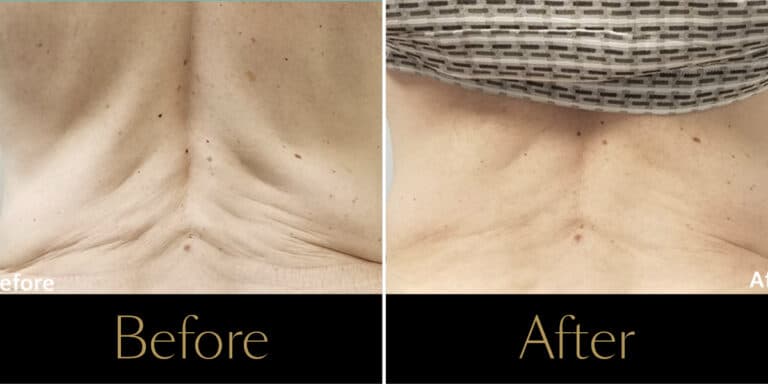 morpheus8-before-after-gallery2