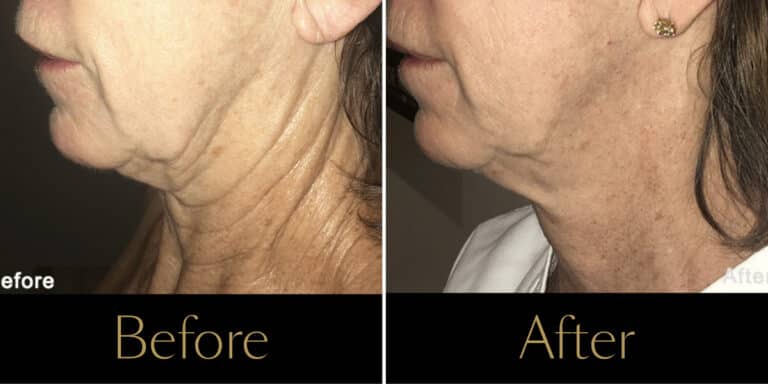 morpheus8-before-after-gallery3