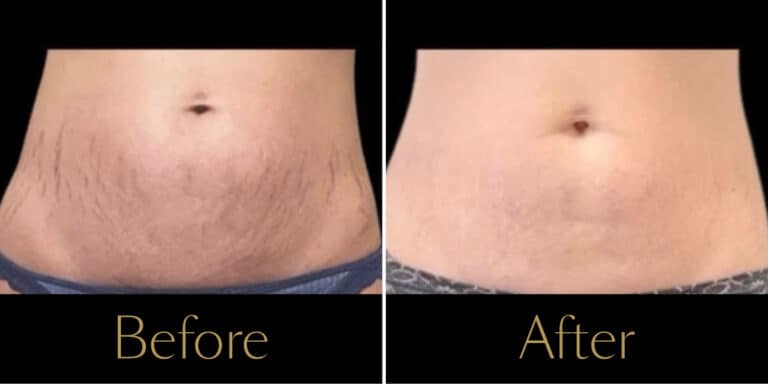 morpheus8-before-after-gallery4