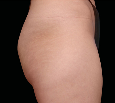 neo-beforeafter-main